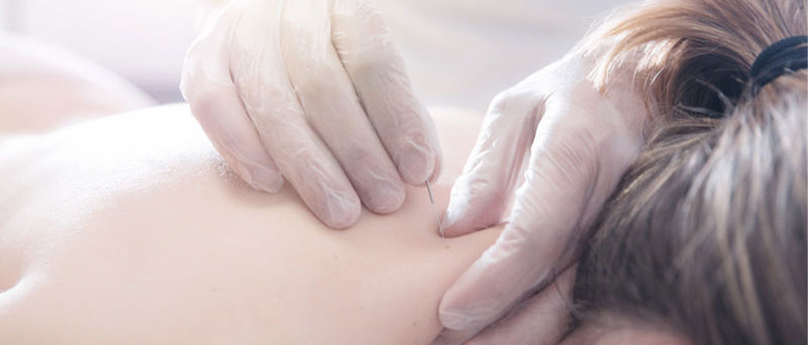 Técnicas de fisioterapia: Puntos gatillo y la punción seca