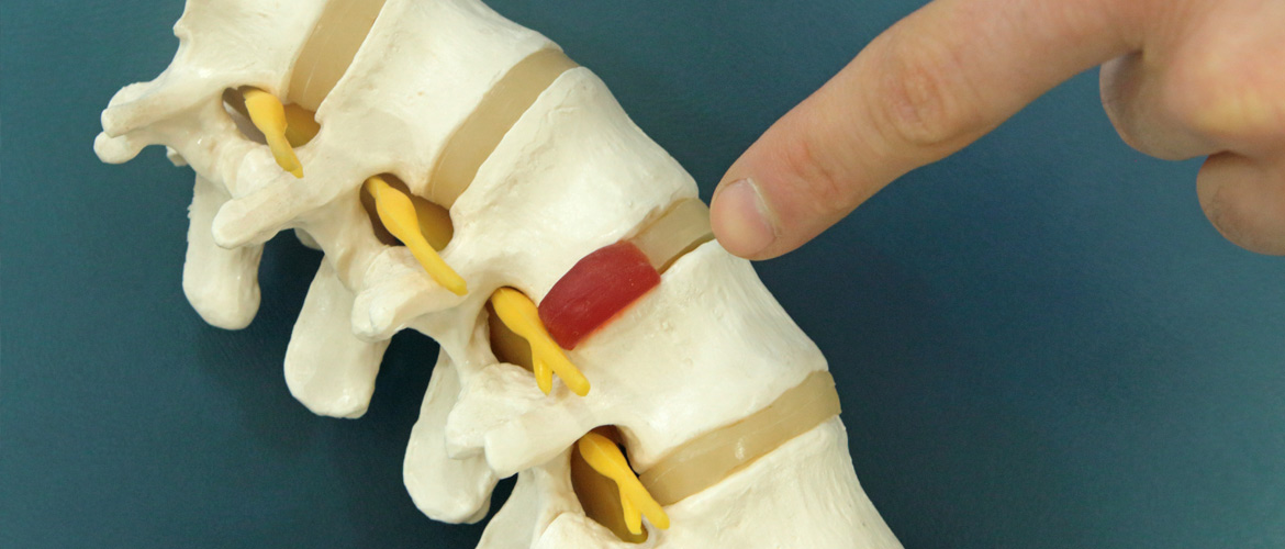 Tratamiento de Hernia Discal en Barcelona