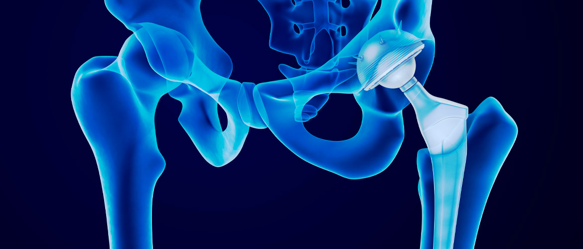 Ejercicio y entrenamiento de fortalecimiento muscular en prótesis de cadera