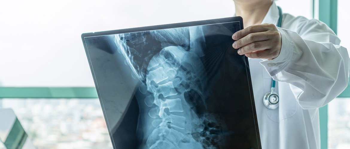 Estenosis lumbar: síntomas y tratamiento